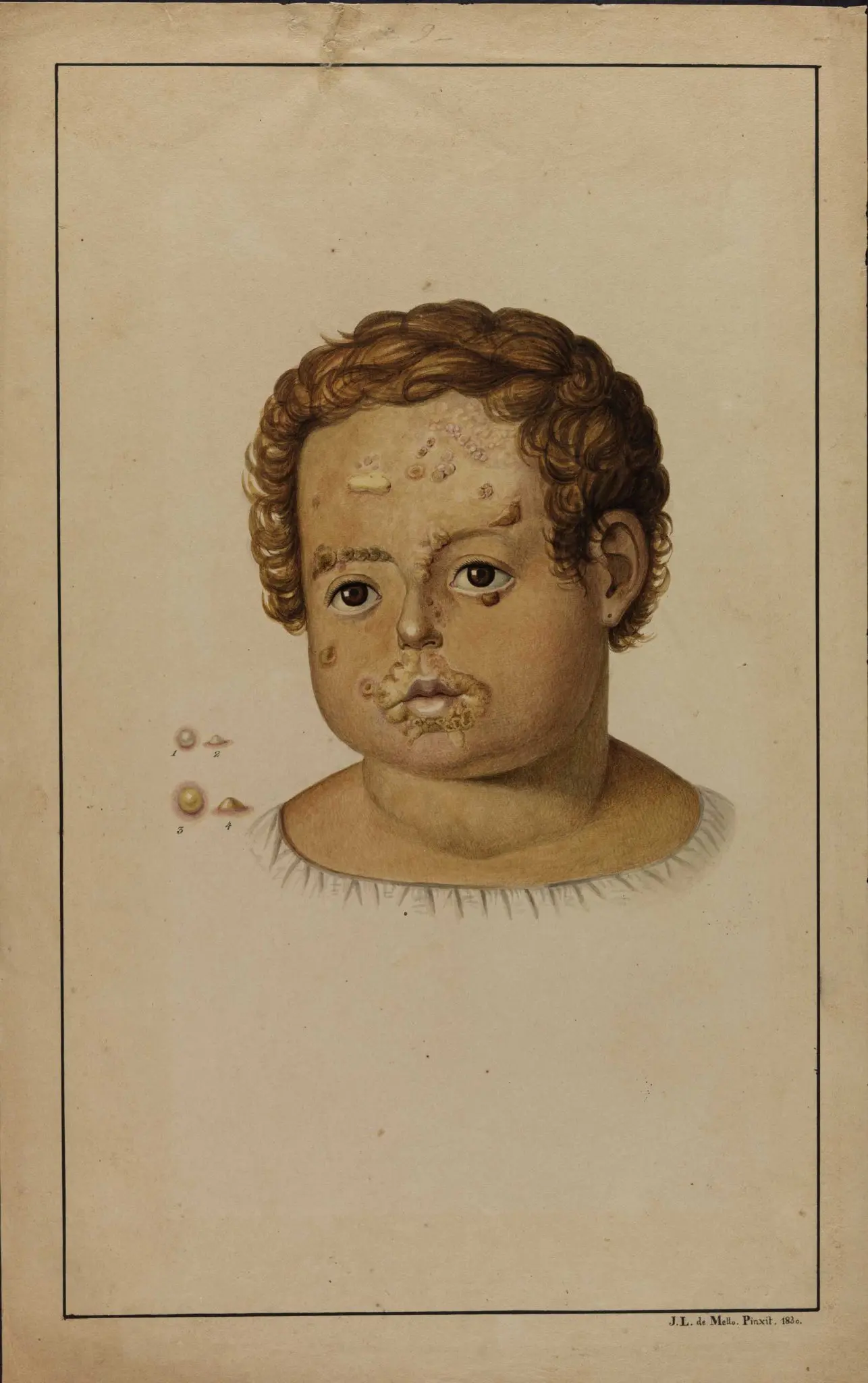Ilustração em preto e branco de rosto de criança com características marcantes e lesões cutâneas.